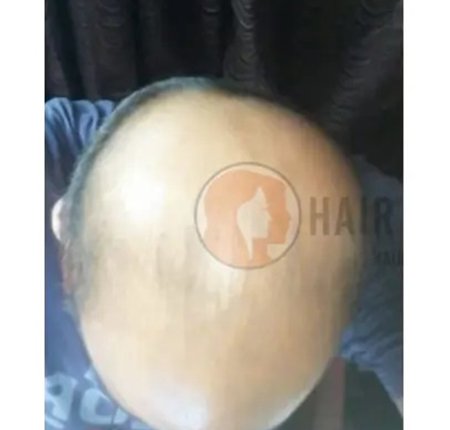 hairloss3-before-hc