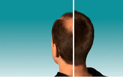 Hair Transplant Clinic in Kukatpally
