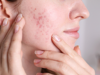 Acne Acne Scars - Hair Creations