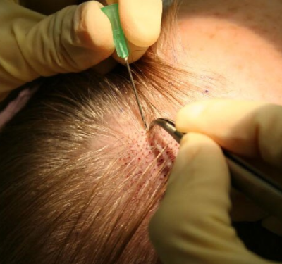 Bio-FUE Hair Transplant H1