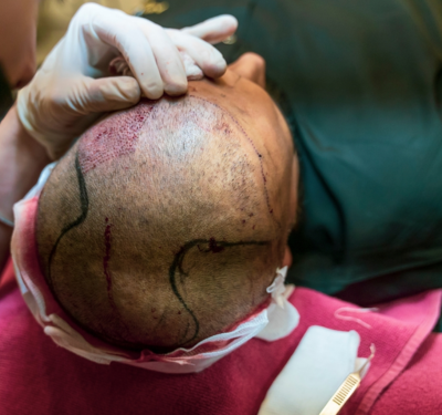 Hair Transplant Clinic H1 Hair_Transplantation