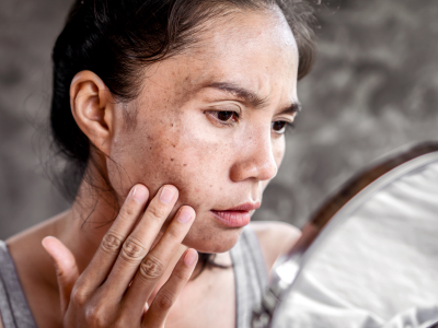 Hyperpigmentation Melasma - Hair Creations