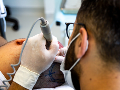 Male Hair Transplant