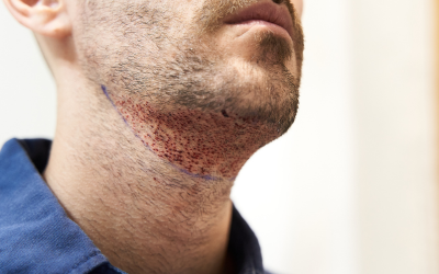 Beard Transplant