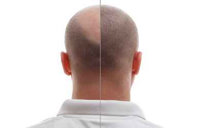 Hair_Transplantation