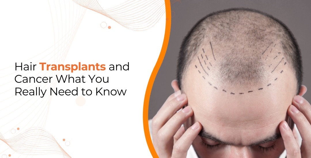Can Hair Transplant Cause Cancer
