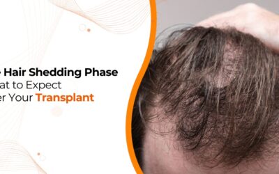 What is the Shedding Phase After Hair Transplant?