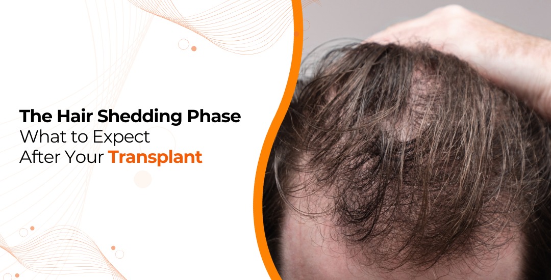 What is the Shedding Phase After Hair Transplant?